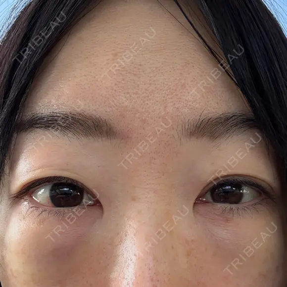 クマ治療 / ボトックス（あご） / 肌ヒアルロン酸注入（たるみ・シワ改善） / ヒアルロン酸注入（目の下） / ボトックス（眉間） / ボトックス（目尻） / ボトックス（額） / その他（鼻） TCB東京中央美容外科 名古屋栄院 BEFORE メイン用