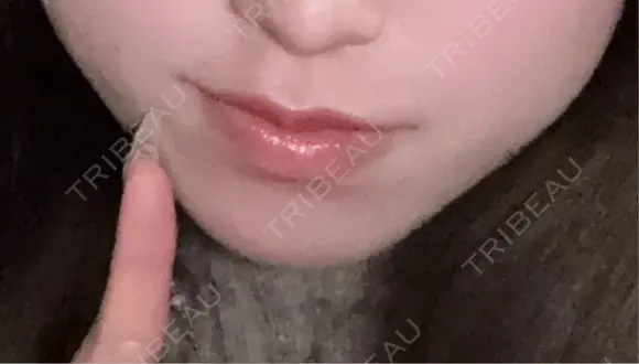 ヒアルロン酸注入（あご） / ボトックス（エラ・小顔） ルラ美容クリニック 横浜院 BEFORE メイン用