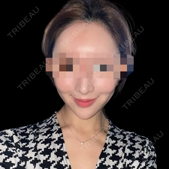 ハイフ（顔） DAILY SKIN CLINIC 福岡院 BEFORE メイン用