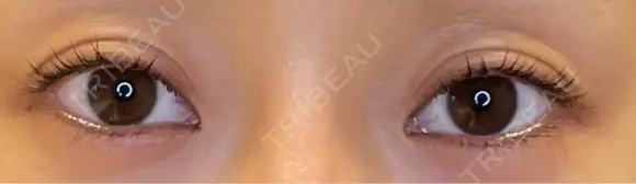 目頭切開 / タレ目形成・グラマラスライン（埋没） LOUIS CLINIC 二子玉川院【ルイクリニック】 BEFORE メイン用