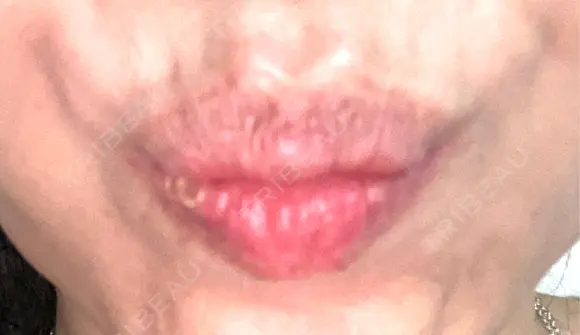 ボトックス（エラ・小顔） / ボトックス（目尻） / ボトックス（人中） 代々木駅前美容クリニック BEFORE メイン用