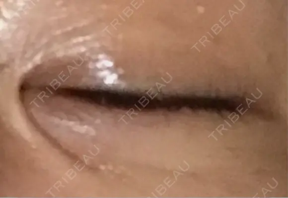 ヒアルロン酸注入（涙袋） アネシス美容クリニック BEFORE メイン用