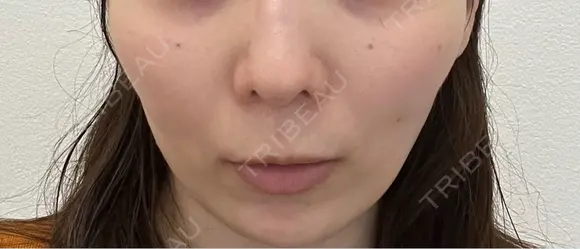 美肌レーザー まゆりなclinic 名古屋栄 BEFORE メイン用