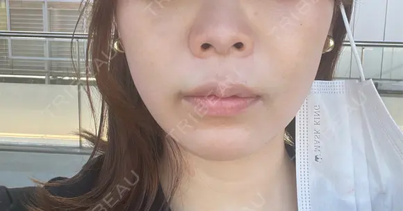 ボトックス（エラ・小顔） ルラ美容クリニック 名古屋本院 BEFORE メイン用