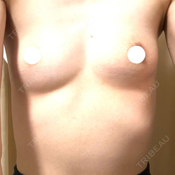 豊胸（シリコンバッグ） / 陥没乳頭形成 BELLMONA CLINIC BEFORE メイン用