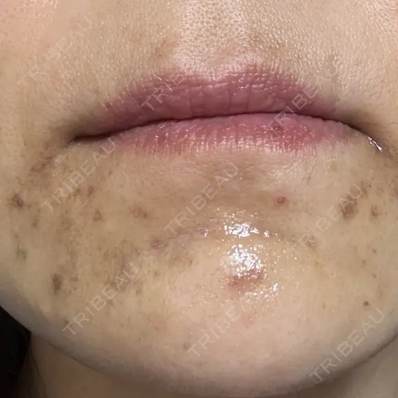 医療脱毛（ワキ） / ルメッカ ルラ美容クリニック 広島院 BEFORE メイン用