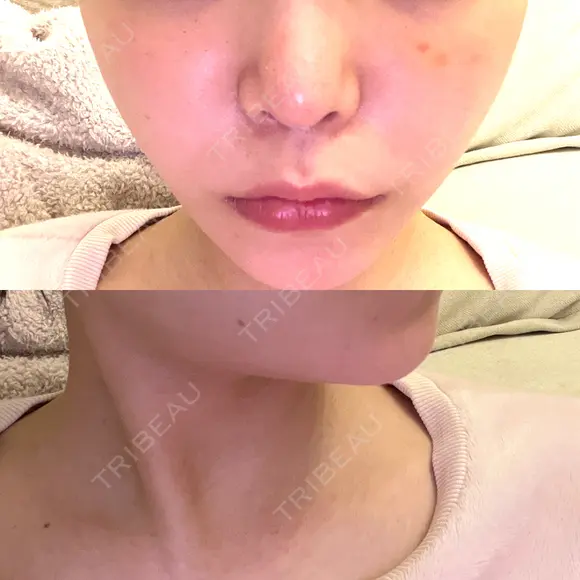 RF（高周波）たるみ治療 オラクル美容皮膚科 東京新宿院 BEFORE メイン用