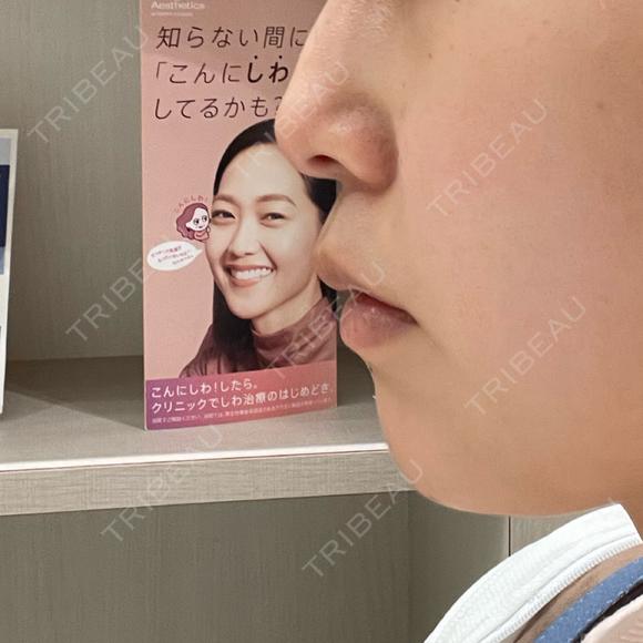 ボトックス（あご） / ヒアルロン酸注入（あご） / ボトックス（エラ・小顔） / ボトックス（口角） / ボトックス（肩） / ボトックス（眉間） / ボトックス（首） 銀座美容外科クリニック 銀座院 BEFORE メイン用