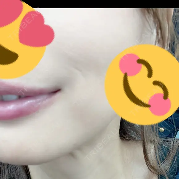 ボトックス（口角） / ワキ汗治療（ボトックス） DMTC CLINIC 日本橋院 BEFORE メイン用