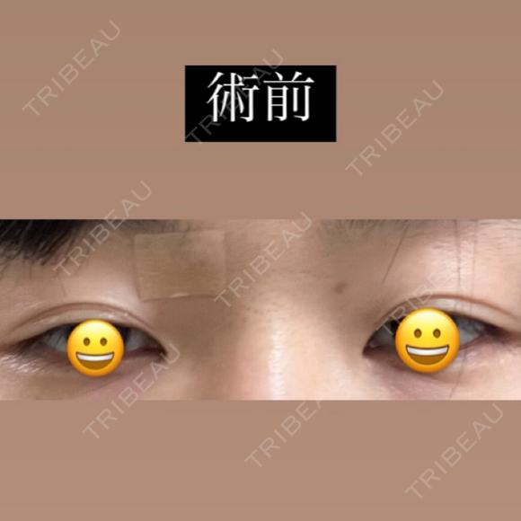 目頭切開 / 目尻切開 / 自然癒着法 LUHO（ルホ）美容外科 BEFORE メイン用