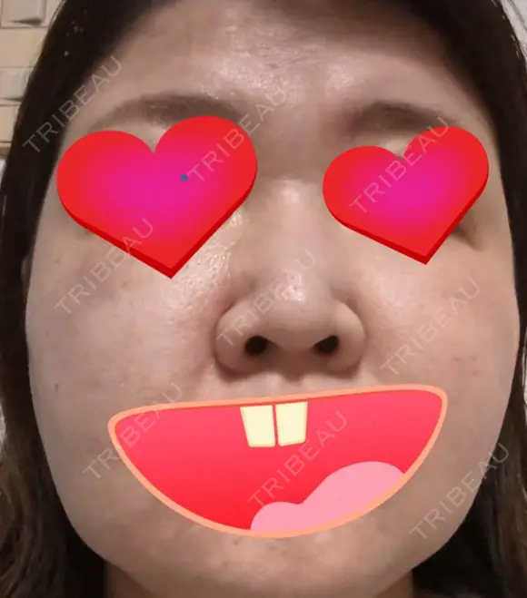 エレクトロポレーション / ピーリング（ハリ・ツヤ） / ルメッカ ルラ美容クリニック 広島院 BEFORE メイン用