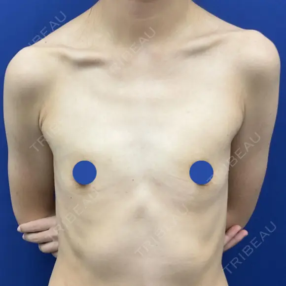 豊胸（脂肪注入） 湘南美容クリニック 吉祥寺院 BEFORE メイン用