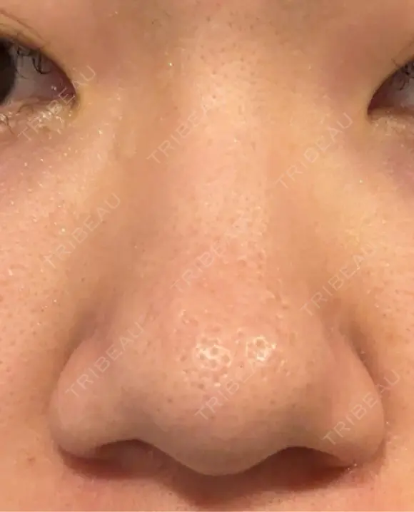 鼻尖形成（切開） / 軟骨移植 / 鼻柱下降・鼻唇角形成（猫手術） 東京美専クリニック BEFORE メイン用