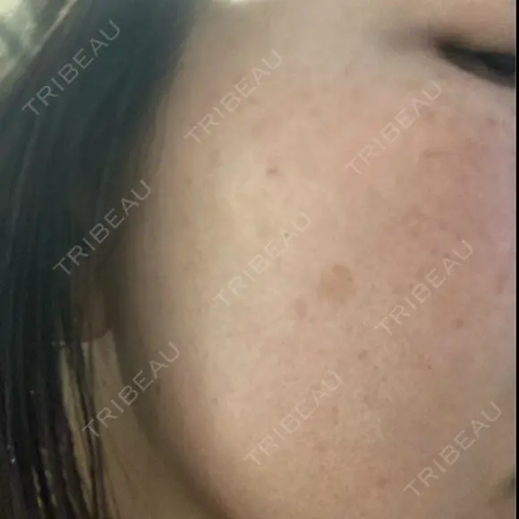 イオン導入 / ルメッカ ルラ美容クリニック 大宮院 / ルラスキンクリニック 大宮院 BEFORE メイン用