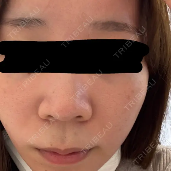 ポテンツァ ルラ美容クリニック 札幌本院 BEFORE メイン用