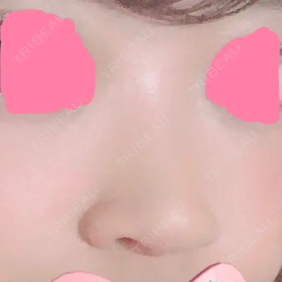 ヒアルロン酸注入（鼻） 神田美容外科形成外科医院 BEFORE メイン用