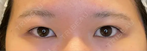 目尻切開 / タレ目形成・グラマラスライン（埋没） LOUIS CLINIC 二子玉川院【ルイクリニック】 BEFORE メイン用