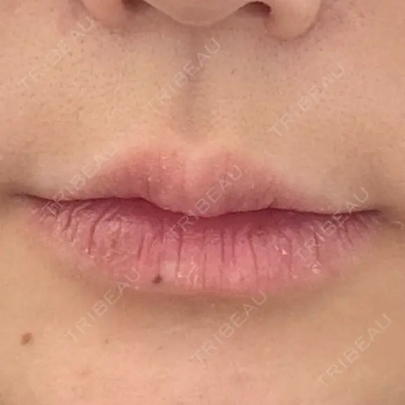 ヒアルロン酸注入（唇） / ボトックス（タレ目） / ボトックス（人中） アネシス美容クリニック BEFORE メイン用