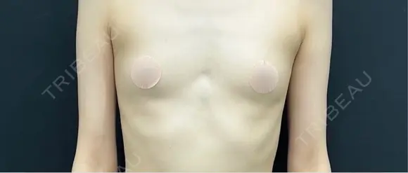 豊胸（脂肪注入） 湘南美容クリニック 吉祥寺院 BEFORE メイン用