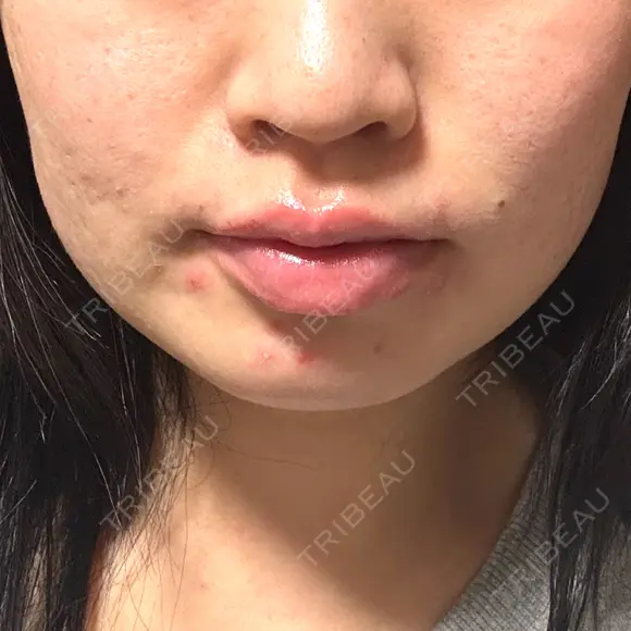 ボトックス（エラ・小顔） BiBiクリニック BEFORE メイン用