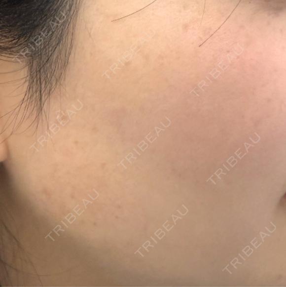 ピーリング（ハリ・ツヤ） / ルメッカ PureMe Skin Clinic（ピュアミースキンクリニック麻布） BEFORE メイン用
