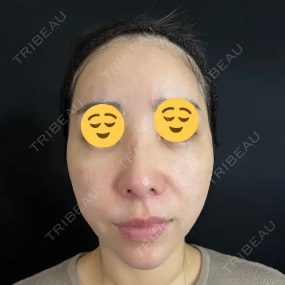 クマ治療 / 脂肪注入（目の下） 藤・ナチュレ美容クリニック 銀座院 BEFORE メイン用