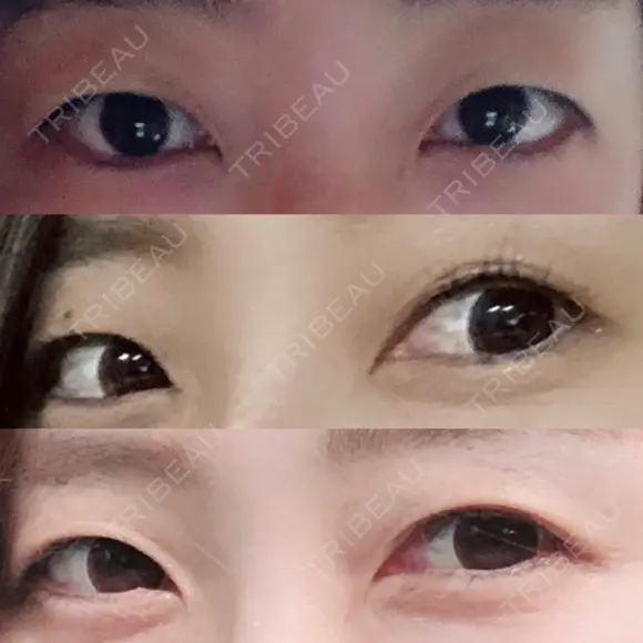 二重埋没 城本クリニック 姫路院 BEFORE メイン用