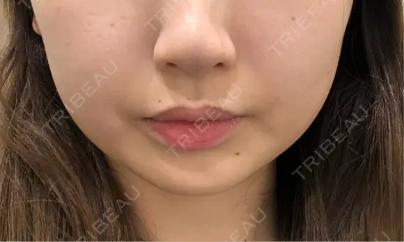 脂肪吸引注射（顔） EMMO FACE CLINIC 東京三田院 BEFORE メイン用