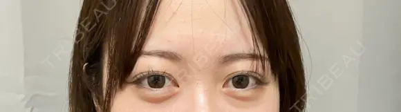 二重埋没 / 目元修正 THE FIRST CLINIC 町田院 BEFORE メイン用