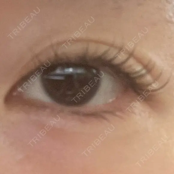 眼瞼下垂（非切開） SOL CLINIC BEFORE メイン用