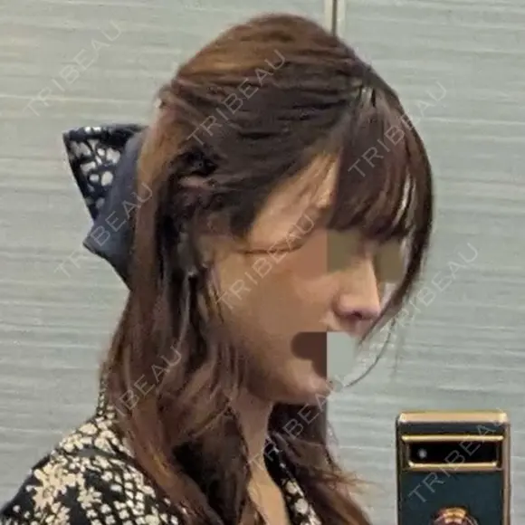 ヒアルロン酸注入（鼻） TCB東京中央美容外科 青森院 BEFORE メイン用