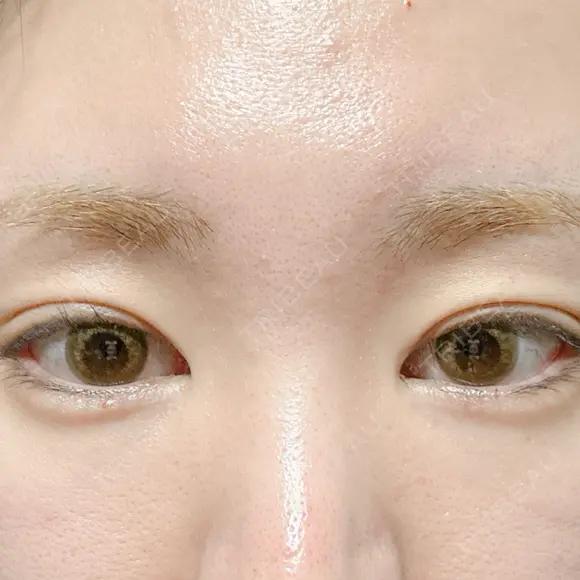 その他（目元） 東京形成美容外科 船橋院 BEFORE メイン用