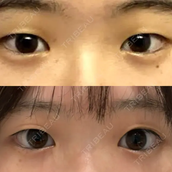 二重切開 水の森美容クリニック 横浜院 BEFORE メイン用