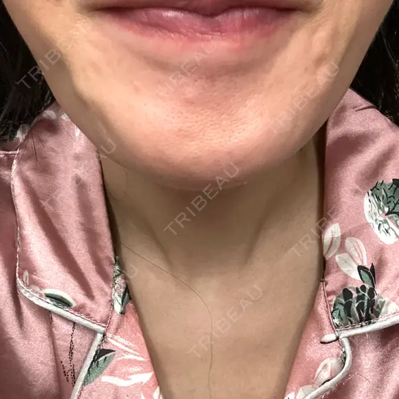 ボトックス（あご） / ボトックス（目尻） ルラ美容クリニック 新宿院 BEFORE メイン用