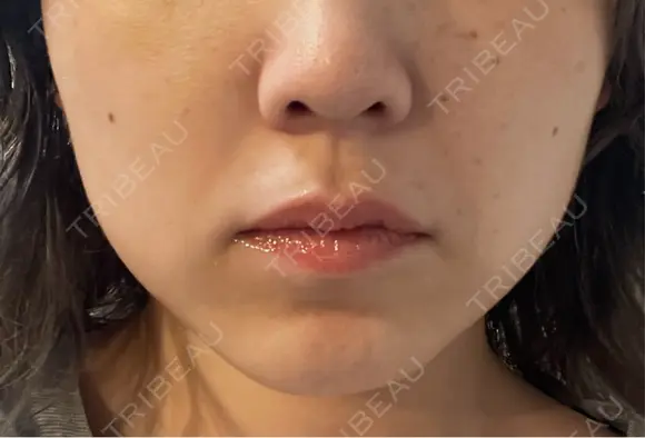 ボトックス（あご） / ボトックス（エラ・小顔） / 脂肪溶解注射（顔） / ボトックス（人中） Kinshicho Beauty Clinic （錦糸町ビューティークリニック） BEFORE メイン用