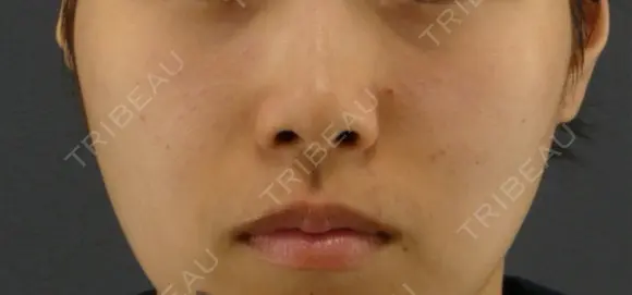 隆鼻術 / 鼻尖形成（切開） / 鼻中隔延長（切開） GRACIA clinic 【グラシアクリニック】 BEFORE メイン用