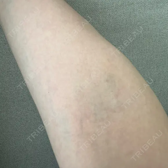 美容点滴・美容注射（疲労回復） グリシーヌクリニック BEFORE メイン用