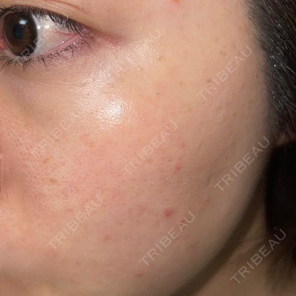ピーリング（ハリ・ツヤ） / ルメッカ PureMe Skin Clinic（ピュアミースキンクリニック麻布） BEFORE メイン用