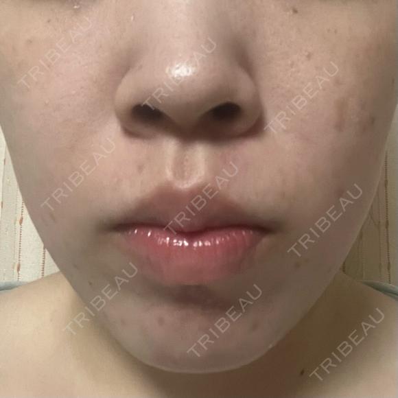 医療脱毛（全身） / ルメッカ Grias clinic （ジリアスクリニック） BEFORE メイン用