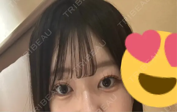 目頭切開 Brandnew Beauty Clinic BEFORE メイン用