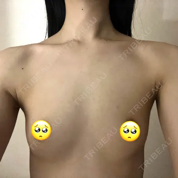 豊胸（シリコンバッグ） さくらビューティークリニック銀座 BEFORE メイン用