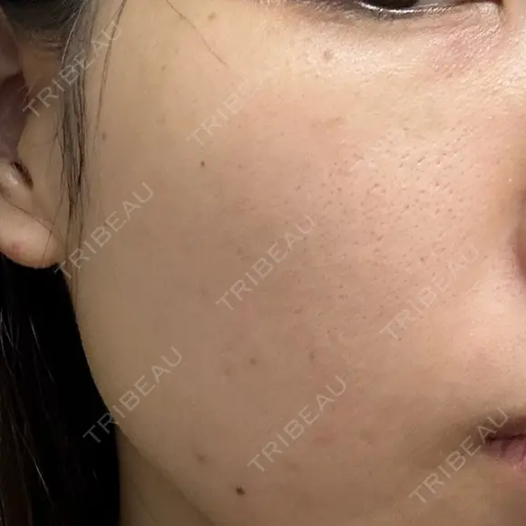 エレクトロポレーション / ルメッカ ON-CLINIC Beauty BEFORE メイン用