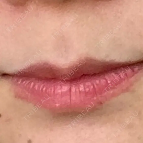 ヒアルロン酸注入（唇） フィラークリニック 大阪梅田院 BEFORE メイン用