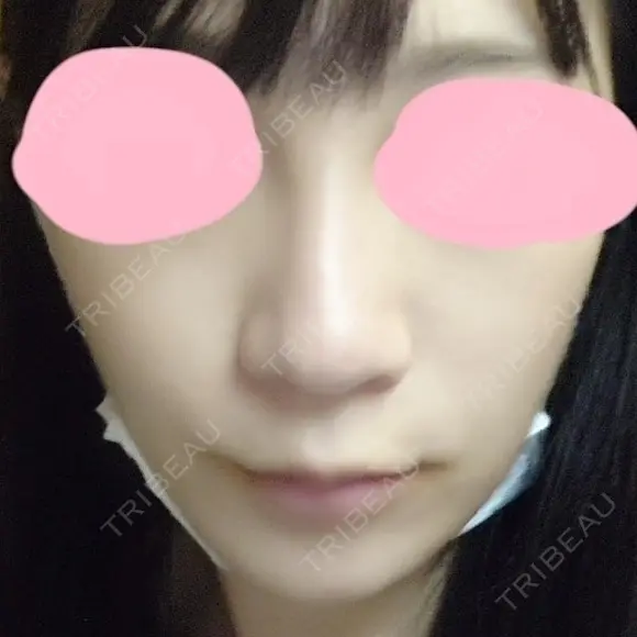 鼻尖形成（切開） / 小鼻縮小（切開） / 軟骨移植 / 骨切幅寄せ HANABI整形外科 BEFORE メイン用