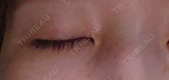 ヒアルロン酸注入（涙袋） ルラ美容クリニック 福岡本院 BEFORE メイン用