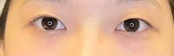 二重埋没 / 目尻切開 / タレ目形成・グラマラスライン（埋没） LOUIS CLINIC 二子玉川院【ルイクリニック】 BEFORE メイン用