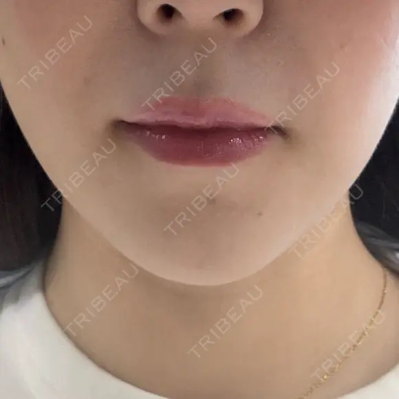 肌ヒアルロン酸注入（たるみ・シワ改善） KIMI CLINIC 形成・美容外科 BEFORE メイン用