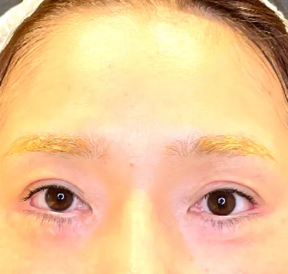 目尻切開 / タレ目形成・グラマラスライン（埋没） LOUIS CLINIC 二子玉川院【ルイクリニック】 BEFORE メイン用