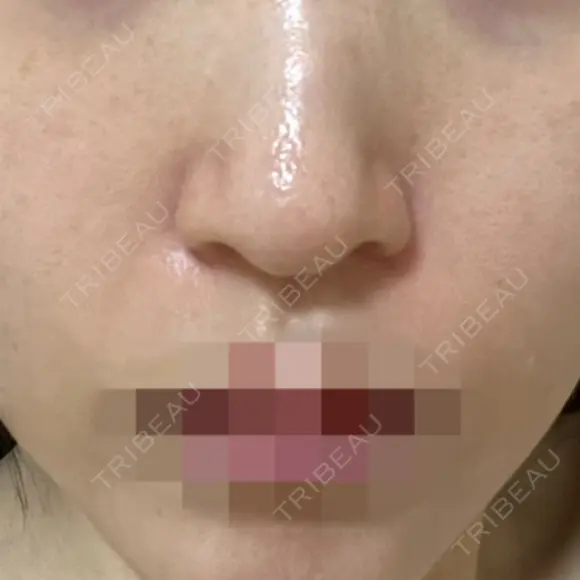 ポテンツァ ルラ美容クリニック 岡山院 BEFORE メイン用