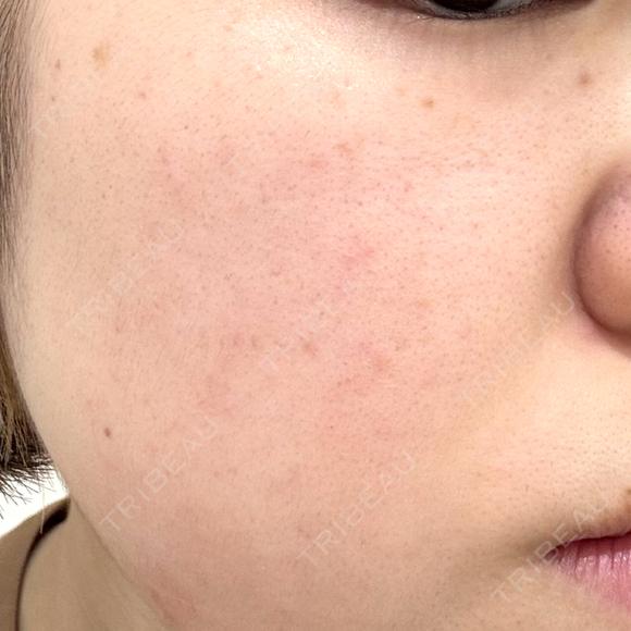 ピーリング（ハリ・ツヤ） / ルメッカ PureMe Skin Clinic（ピュアミースキンクリニック麻布） BEFORE メイン用